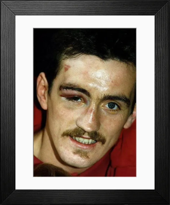  : Boxer, Barry McGuigan, shows off his bruises after one of his fights. 1st June 1989
