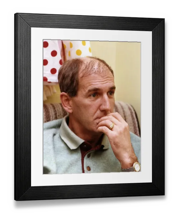 Framed Print : Russ Abbot in a theatre dressing room shows his Hair Transplant A©Mirrorpix
