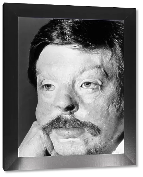 Soldier Simon Weston, scarred during an Argentine attack on Sir Galahad troopship in