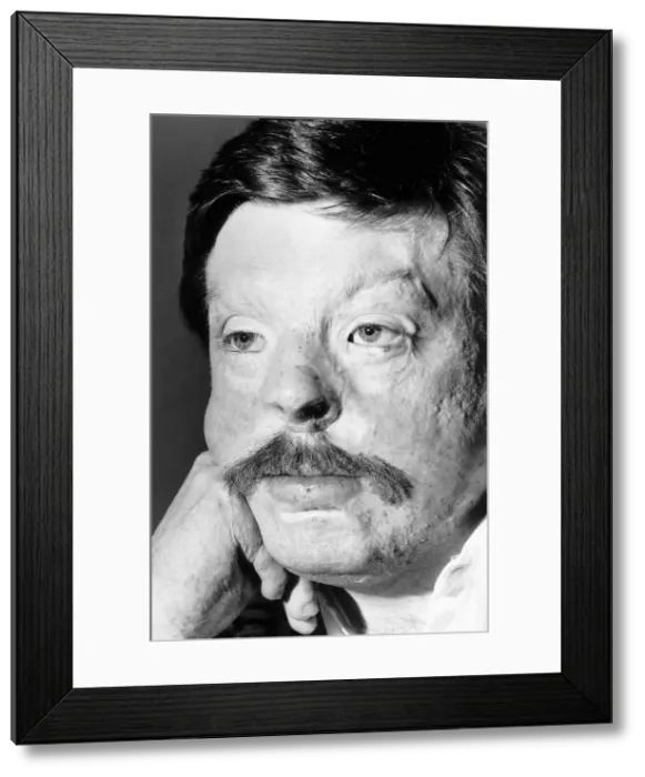 Framed Print : Soldier Simon Weston, scarred during an Argentine attack on Sir Galahad troopship in Framed Print : Soldier Simon Weston, scarred during an Argentine attack on Sir Galahad troopship in