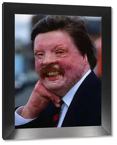 Simon Weston a Falklands War casuality seen here in April 1989