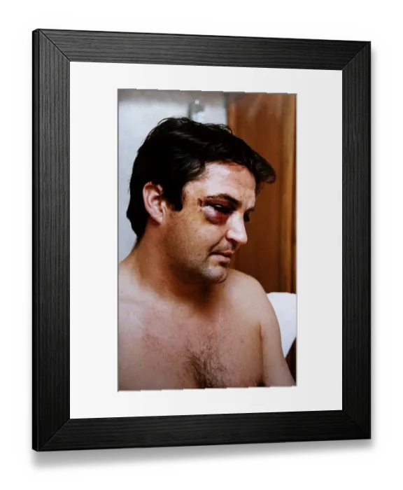 Framed Print : Gary Mabbutt Football shows off the bruising on his face from having his cheek jaw broken Framed Print : Gary Mabbutt Football shows off the bruising on his face from having his cheek jaw broken