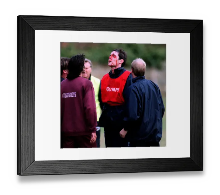Framed Print : Heart of Midlothian footballer David Weir with a bloody face after a clash with teammate Framed Print : Heart of Midlothian footballer David Weir with a bloody face after a clash with teammate