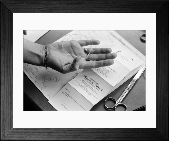 Framed Print : Smallpox Outbreak Birmingham 1978. Janet Parker a British medical photographer became