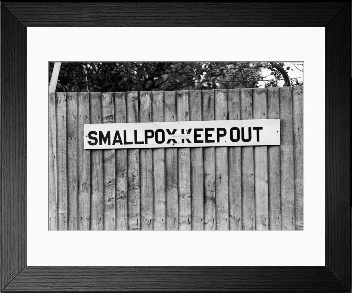 Framed Print : Smallpox Outbreak Birmingham 1978. Janet Parker a British medical photographer became Framed Print : Smallpox Outbreak Birmingham 1978. Janet Parker a British medical photographer became
