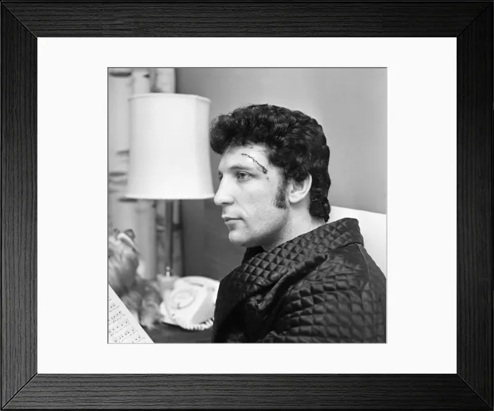 Framed Print : Singer Tom Jones at home with stitched head wound caused by a recent car crash Framed Print : Singer Tom Jones at home with stitched head wound caused by a recent car crash