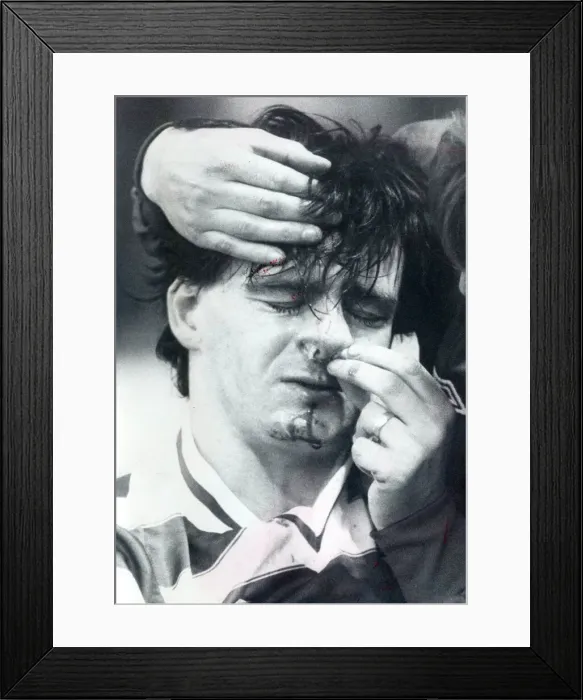 Framed Print : Charlie Nicholas Celtic player injured 1982 celtic player charlie nicholas with a
