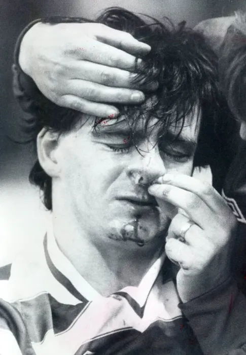 Framed Print : Charlie Nicholas Celtic player injured 1982 celtic player charlie nicholas with a