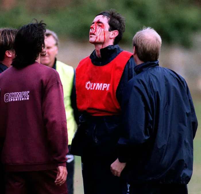 Framed Print : Heart of Midlothian footballer David Weir with a bloody face after a clash with teammate Framed Print : Heart of Midlothian footballer David Weir with a bloody face after a clash with teammate