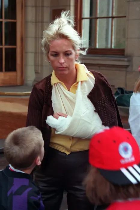 Framed Print : Sheryl Gascoigne with bruised marks made by Gazza wearing bandage sling round arm brown