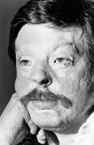 Soldier Simon Weston, scarred during an Argentine attack on Sir Galahad troopship in