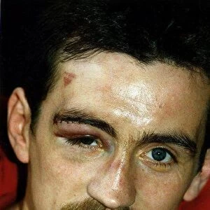 Boxer, Barry McGuigan, shows off his bruises after one of his fights. 1st June 1989