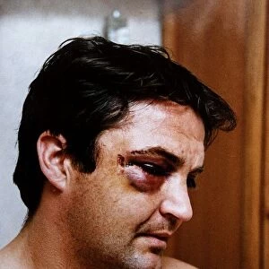 Gary Mabbutt Football shows off the bruising on his face from having his cheek jaw broken