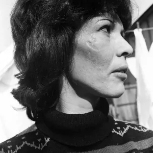 Print of a woman with facial scar from removed anchor tattoo