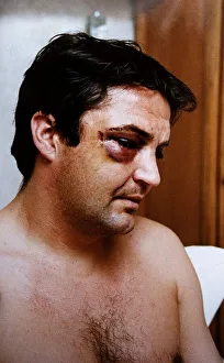 Gary Mabbutt Football shows off the bruising on his face from having his cheek jaw broken