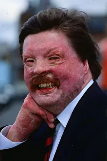 Medical Prints: Simon Weston a Falklands War casuality seen here in April 1989