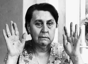 Stigmata sufferer Ethel Chapman shows her palms bearing the marks of the wounds of